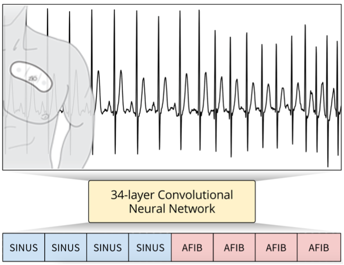 Arrhythmia Detection with Convolutional Neural Networks [3].